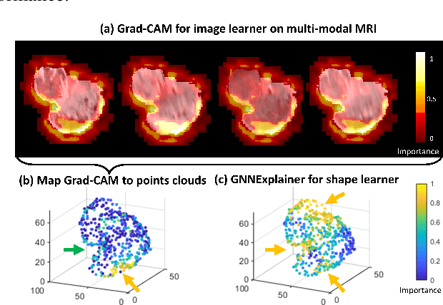 Figure 4 for Collaborative learning of images and geometrics for predicting isocitrate dehydrogenase status of glioma