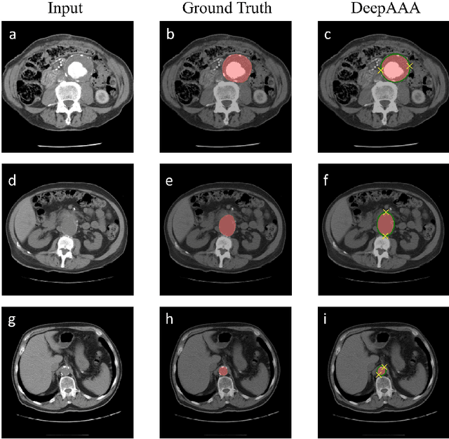 Figure 2 for DeepAAA: clinically applicable and generalizable detection of abdominal aortic aneurysm using deep learning