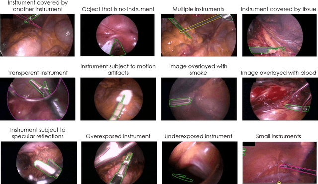 Figure 4 for Heidelberg Colorectal Data Set for Surgical Data Science in the Sensor Operating Room