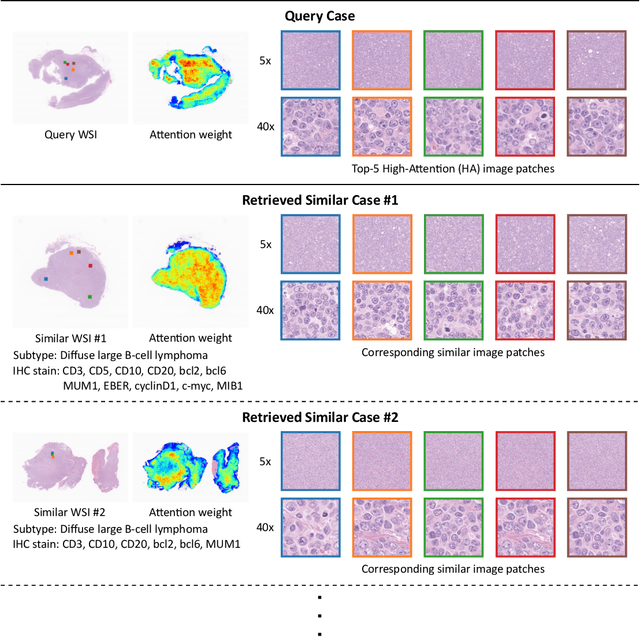 Figure 1 for Case-based similar image retrieval for weakly annotated large histopathological images of malignant lymphoma using deep metric learning