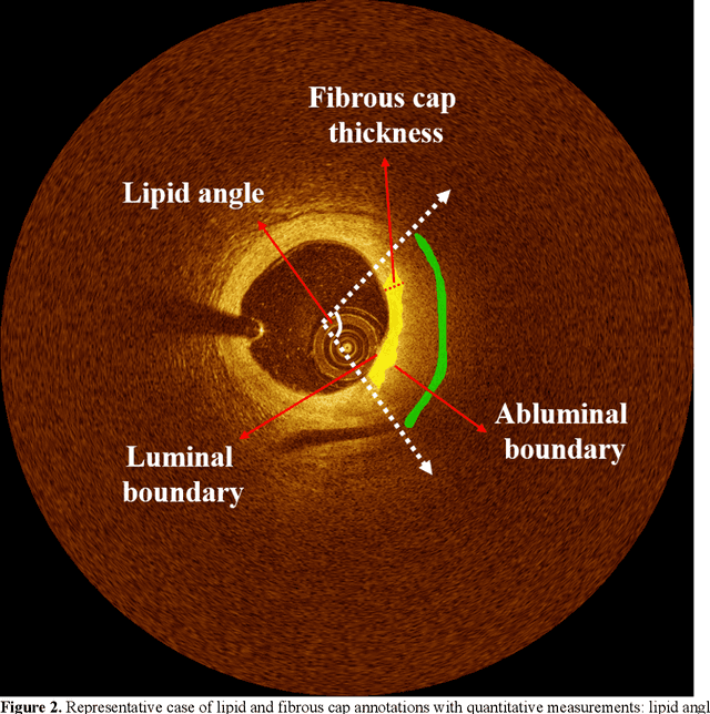 Figure 2 for Automated analysis of fibrous cap in intravascular optical coherence tomography images of coronary arteries
