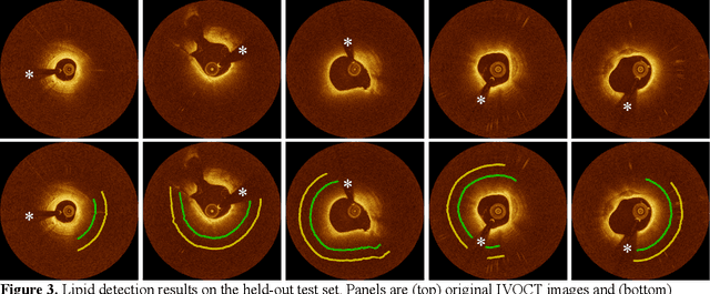 Figure 3 for Automated analysis of fibrous cap in intravascular optical coherence tomography images of coronary arteries