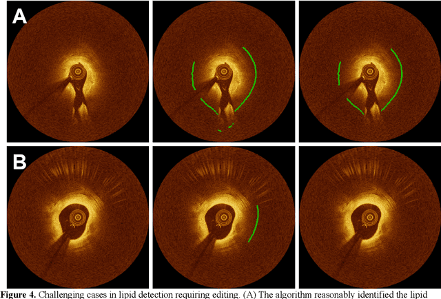 Figure 4 for Automated analysis of fibrous cap in intravascular optical coherence tomography images of coronary arteries