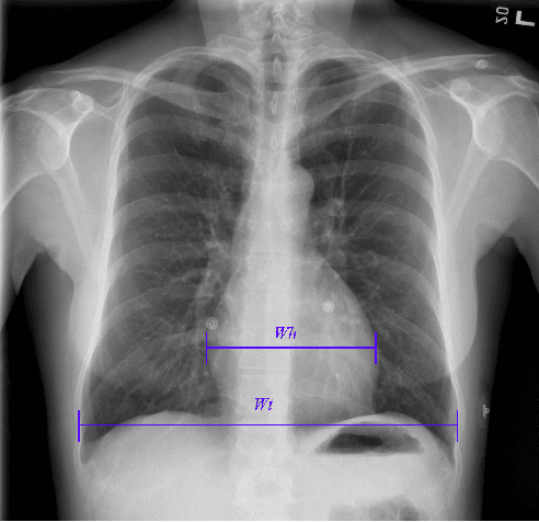 Figure 1 for Deep Learning Models for Calculation of Cardiothoracic Ratio from Chest Radiographs for Assisted Diagnosis of Cardiomegaly