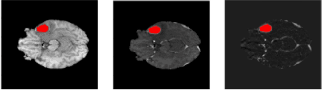 Figure 1 for A Novel Mask R-CNN Model to Segment Heterogeneous Brain Tumors through Image Subtraction