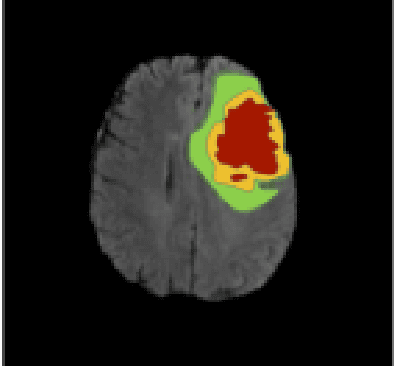 Figure 2 for A Novel Mask R-CNN Model to Segment Heterogeneous Brain Tumors through Image Subtraction