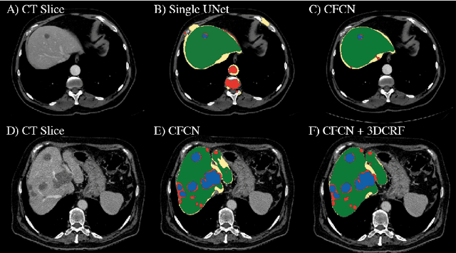 Figure 1 for Automatic Liver and Lesion Segmentation in CT Using Cascaded Fully Convolutional Neural Networks and 3D Conditional Random Fields