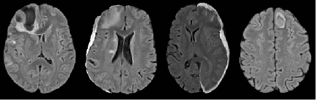 Figure 1 for TBI Contusion Segmentation from MRI using Convolutional Neural Networks