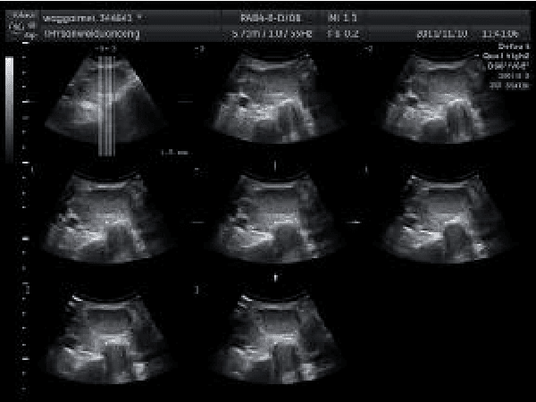 Figure 1 for Segmentation of ultrasound images of thyroid nodule for assisting fine needle aspiration cytology