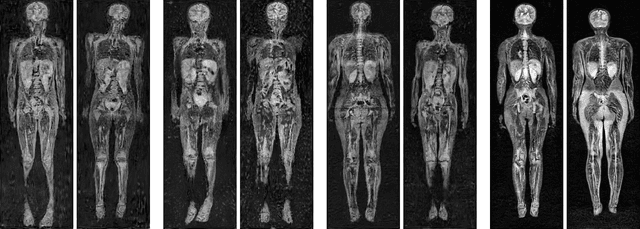 Figure 1 for Using Generative Models for Pediatric wbMRI