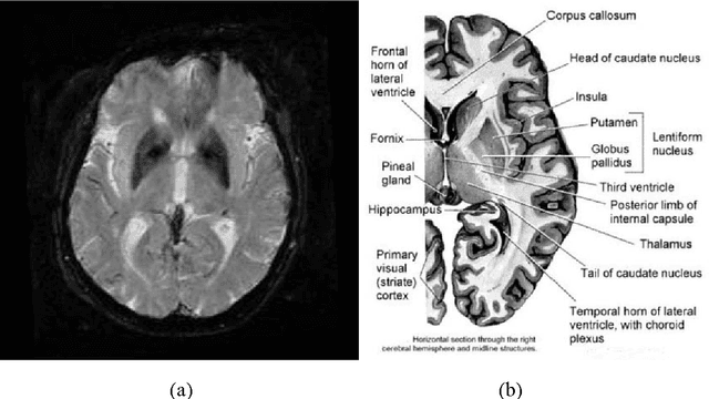 Figure 3 for Binary and nonbinary description of hypointensity in human brain MR images