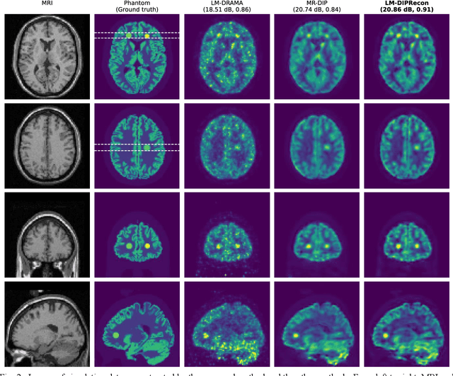 Figure 2 for List-Mode PET Image Reconstruction Using Deep Image Prior