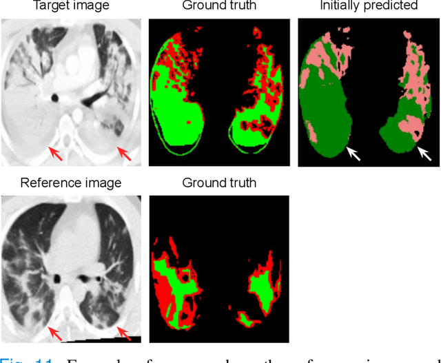 Figure 3 for Interactive Segmentation for COVID-19 Infection Quantification on Longitudinal CT scans