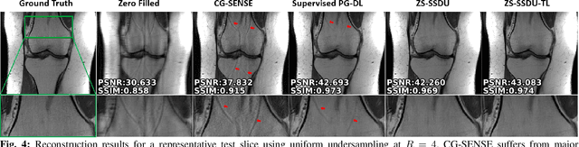 Figure 4 for Scan-Specific MRI Reconstruction using Zero-Shot Physics-Guided Deep Learning