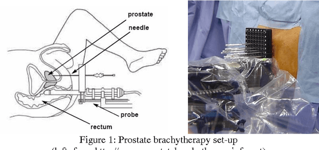 Figure 1 for Prosper: image and robot-guided prostate brachytherapy