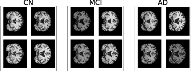 Figure 2 for Alzheimer's Disease Brain MRI Classification: Challenges and Insights