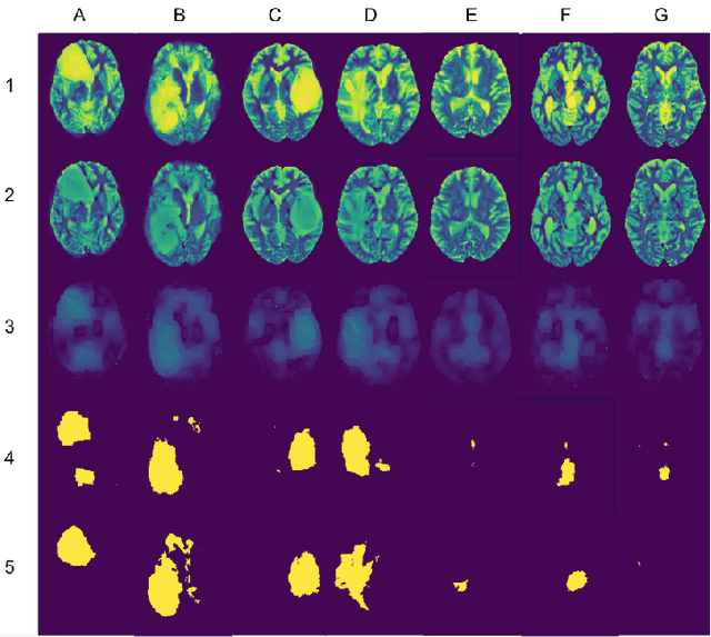 Figure 1 for Unsupervised Lesion Detection via Image Restoration with a Normative Prior