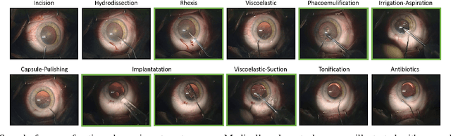 Figure 1 for Relevance Detection in Cataract Surgery Videos by Spatio-Temporal Action Localization