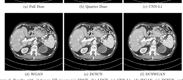 Figure 3 for Low-Dose CT via Deep CNN with Skip Connection and Network in Network