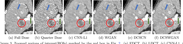 Figure 4 for Low-Dose CT via Deep CNN with Skip Connection and Network in Network