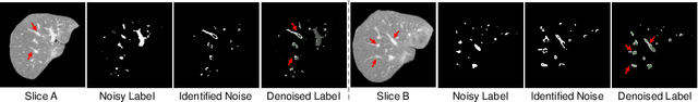 Figure 4 for Noisy Labels are Treasure: Mean-Teacher-Assisted Confident Learning for Hepatic Vessel Segmentation