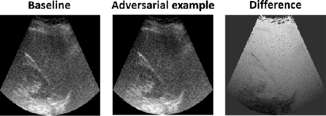 Figure 3 for Adversarial attacks on deep learning models for fatty liver disease classification by modification of ultrasound image reconstruction method