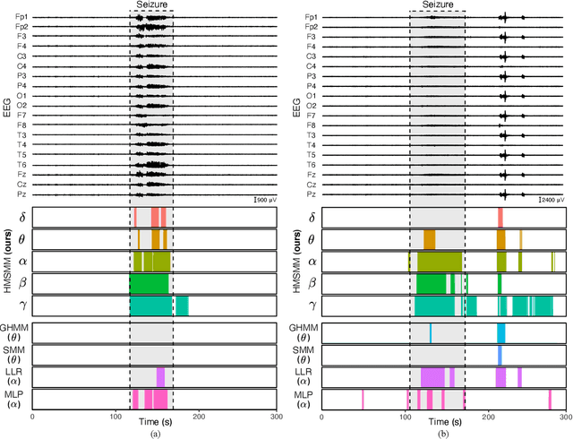 Figure 2 for A Time-Series Scale Mixture Model of EEG with a Hidden Markov Structure for Epileptic Seizure Detection