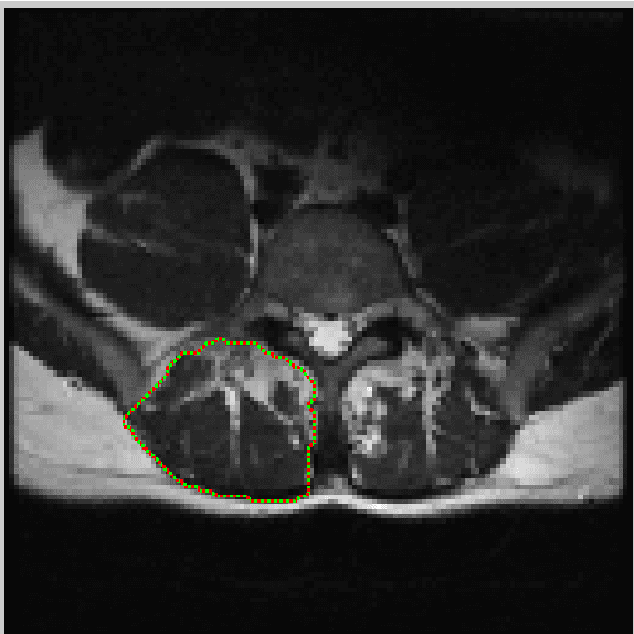 Figure 3 for An Interactive Segmentation Tool for Quantifying Fat in Lumbar Muscles using Axial Lumbar-Spine MRI