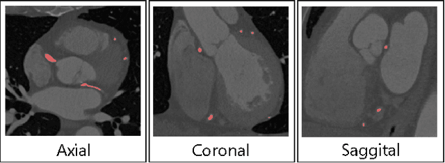 Figure 1 for Multi-Resolution 3D Convolutional Neural Networks for Automatic Coronary Centerline Extraction in Cardiac CT Angiography Scans