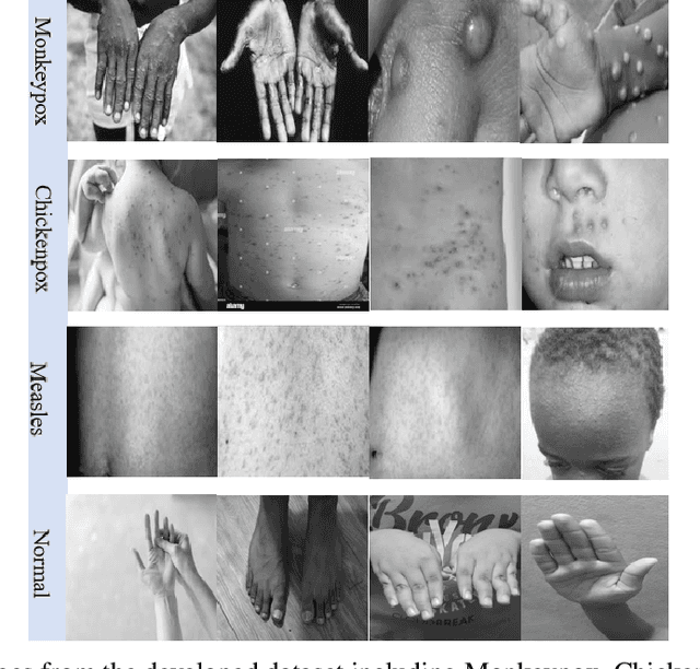 Figure 4 for Image Data collection and implementation of deep learning-based model in detecting Monkeypox disease using modified VGG16