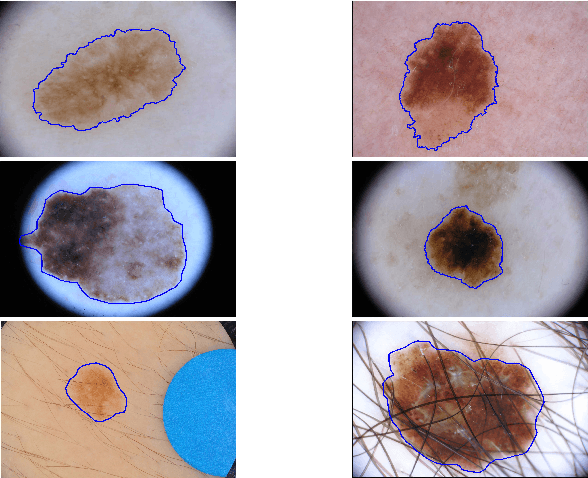 Figure 1 for Global and Local Information Based Deep Network for Skin Lesion Segmentation