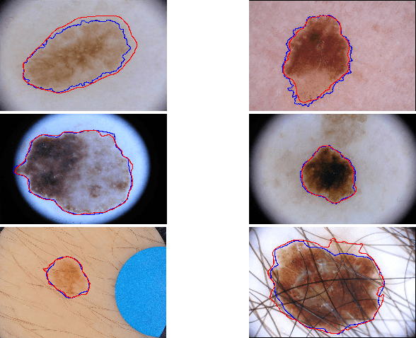 Figure 3 for Global and Local Information Based Deep Network for Skin Lesion Segmentation