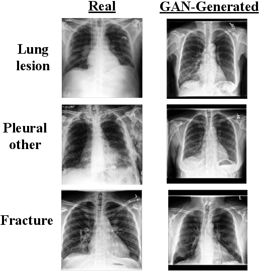 Figure 3 for GAN-based Data Augmentation for Chest X-ray Classification