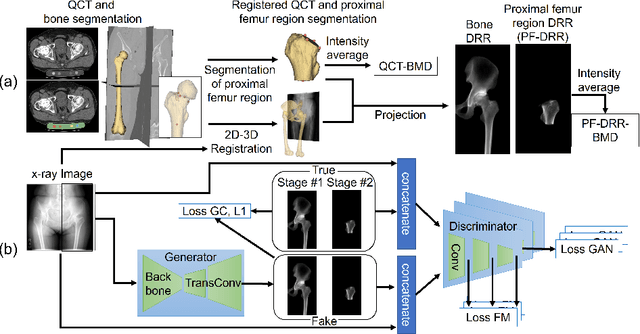 Figure 1 for BMD-GAN: Bone mineral density estimation using x-ray image decomposition into projections of bone-segmented quantitative computed tomography using hierarchical learning