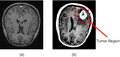 Figure 1 for Examining the behaviour of state-of-the-art convolutional neural networks for brain tumor detection with and without transfer learning