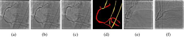 Figure 1 for Deep Segmentation and Registration in X-Ray Angiography Video