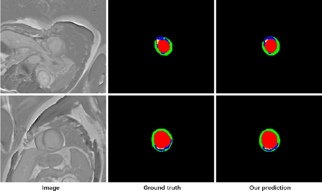 Figure 4 for Cascaded Convolutional Neural Network for Automatic Myocardial Infarction Segmentation from Delayed-Enhancement Cardiac MRI