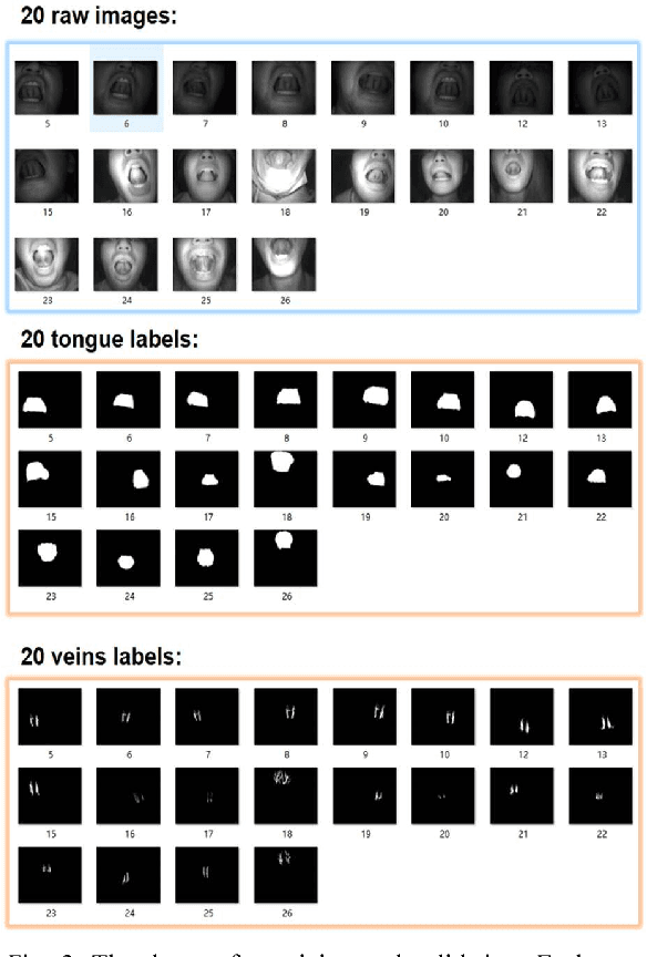 Figure 4 for Fully Automatic Segmentation of Sublingual Veins from Retrained U-Net Model for Few Near Infrared Images