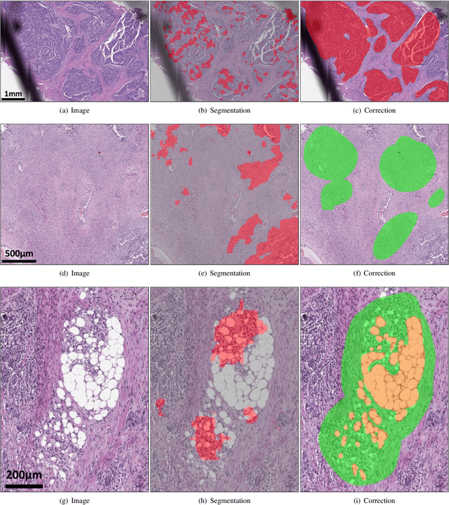 Figure 4 for Deep Interactive Learning-based ovarian cancer segmentation of H&E-stained whole slide images to study morphological patterns of BRCA mutation
