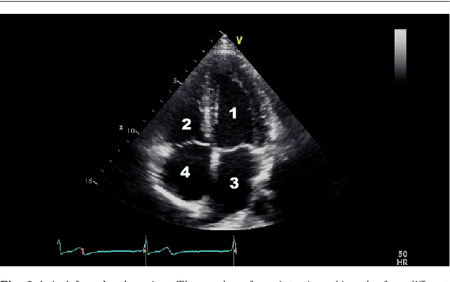 Figure 3 for Fully Automated 2D and 3D Convolutional Neural Networks Pipeline for Video Segmentation and Myocardial Infarction Detection in Echocardiography