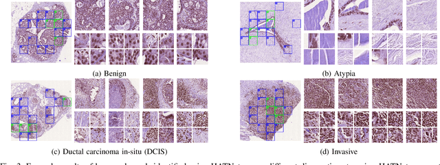 Figure 3 for HATNet: An End-to-End Holistic Attention Network for Diagnosis of Breast Biopsy Images