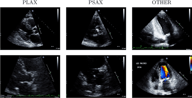 Figure 3 for A New Semi-supervised Learning Benchmark for Classifying View and Diagnosing Aortic Stenosis from Echocardiograms