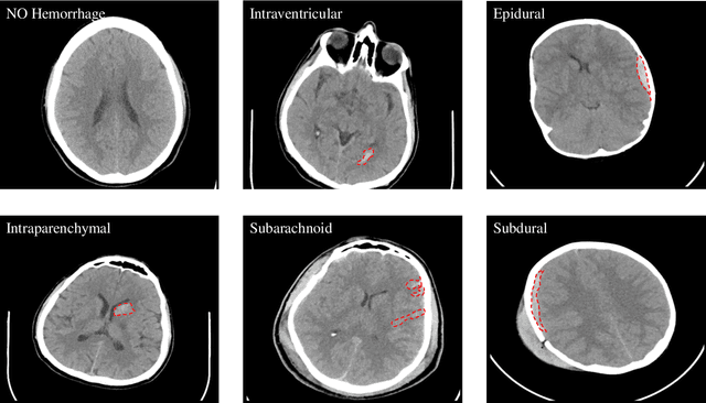 Figure 3 for Intracranial Hemorrhage Segmentation Using Deep Convolutional Model