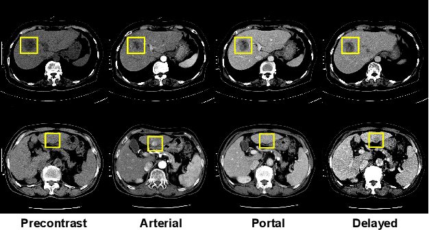 Figure 1 for Liver Lesion Detection from Weakly-labeled Multi-phase CT Volumes with a Grouped Single Shot MultiBox Detector