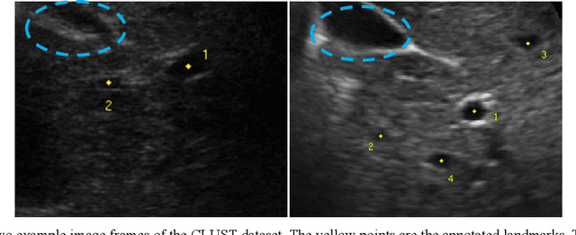 Figure 1 for Landmark Tracking in Liver US images Using Cascade Convolutional Neural Networks with Long Short-Term Memory