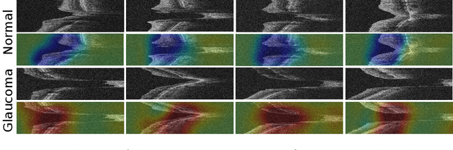 Figure 3 for Unifying Structure Analysis and Surrogate-driven Function Regression for Glaucoma OCT Image Screening