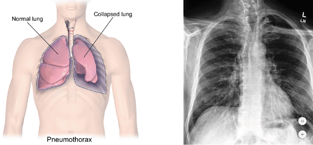 Figure 1 for Searching for Pneumothorax in Half a Million Chest X-Ray Images