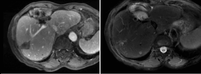 Figure 1 for Comparing Deep Learning strategies for paired but unregistered multimodal segmentation of the liver in T1 and T2-weighted MRI