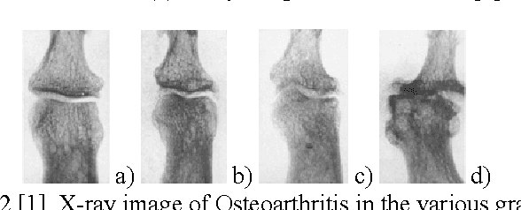 Figure 1 for An Application of Backpropagation Artificial Neural Network Method for Measuring The Severity of Osteoarthritis