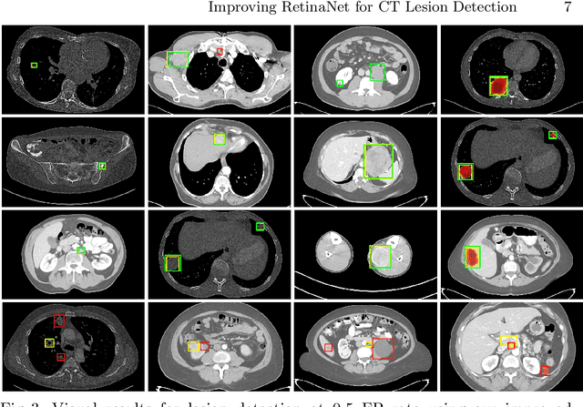 Figure 4 for Improving RetinaNet for CT Lesion Detection with Dense Masks from Weak RECIST Labels